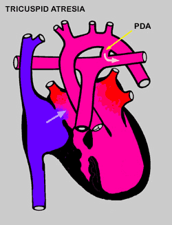 Tricuspid Atresia